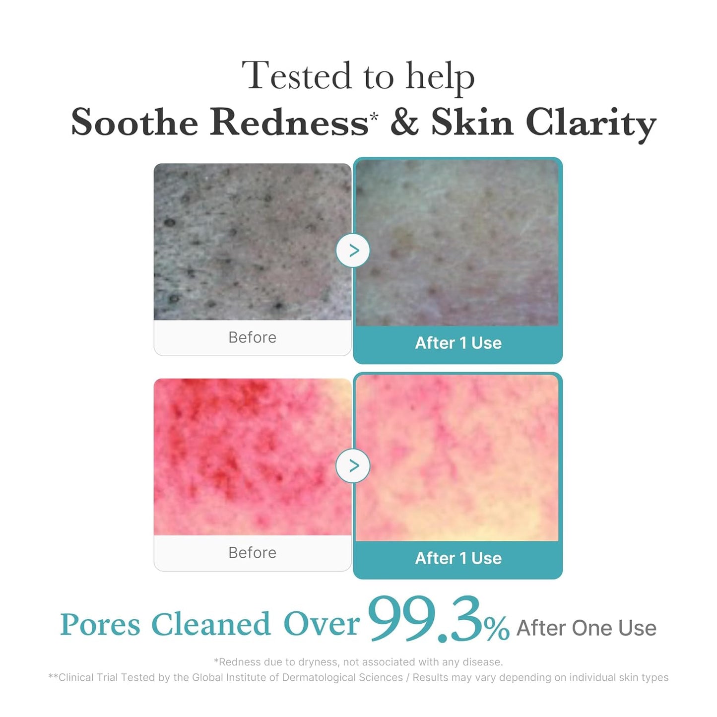 Azelaic Acid Gummy Whip Cleanser | Cleansing Foam for Troubled Skin | Use after Spot Care & Excess Sebum Control | Niacinamide, Glycerin | Soothing, Pore Cleansing Face Wash | Korean Skincare