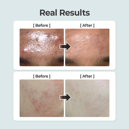 No.1 Toner | Pure-Full Calming Herb Toner | Breakouts, Redness, Excess Oil Control | Centella Asiatica, Heartleaf, Licorice Root | Acne-Prone, Sensitive Skin | 10.14 Fl. Oz.