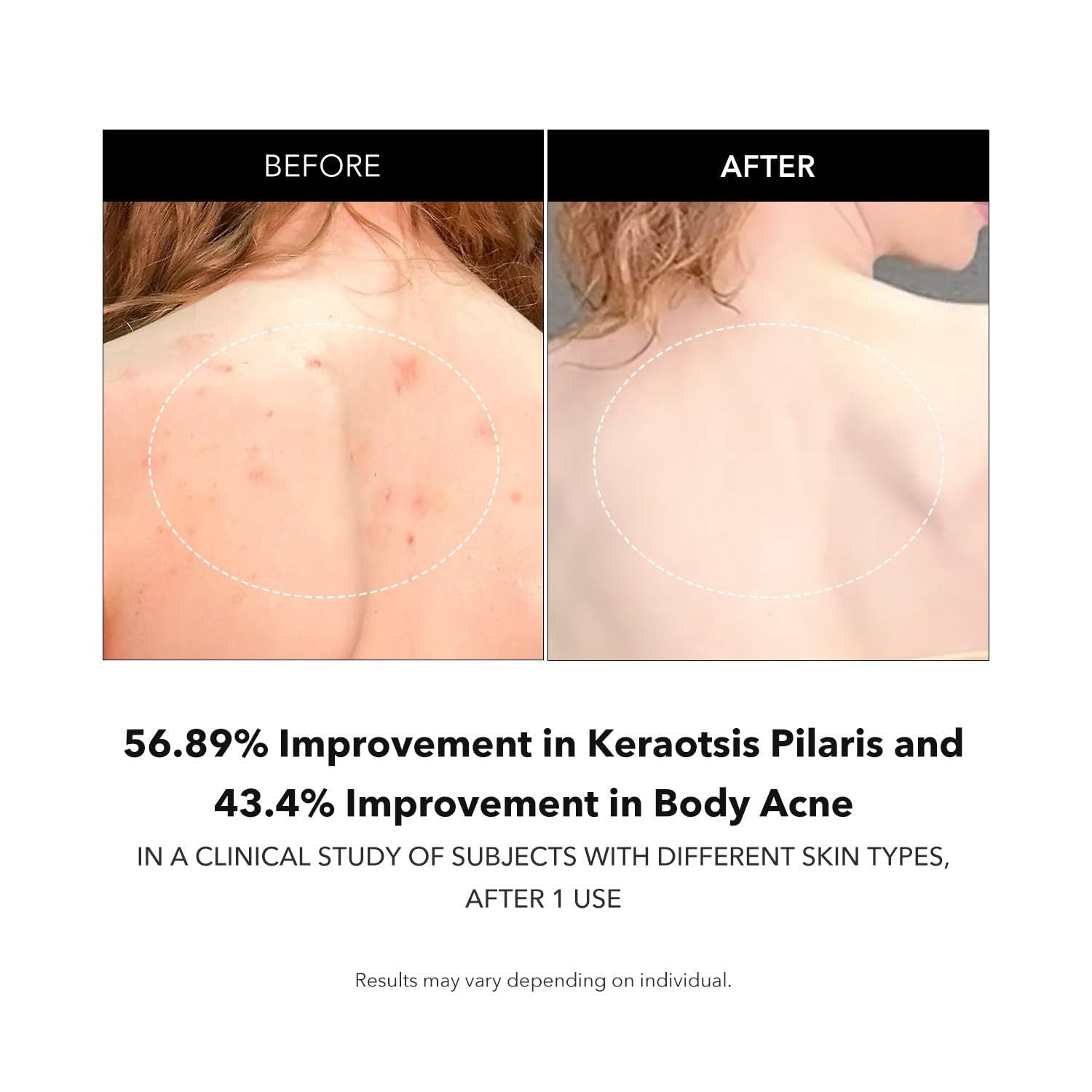 Carrotene IPMP™ Exfoliating Body Wash | Salicylic Acid Body Wash Improve Rough & Bumpy Skin, Body Acne, Keratosis Pilaris with Niacinamide & Ceramides | Vegan & Cruelty-Free | 10.14 Fl.Oz