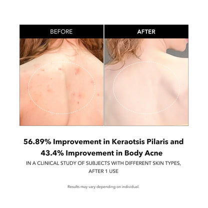 Carrotene IPMP™ Exfoliating Body Wash | Salicylic Acid Body Wash Improve Rough & Bumpy Skin, Body Acne, Keratosis Pilaris with Niacinamide & Ceramides | Vegan & Cruelty-Free | 10.14 Fl.Oz