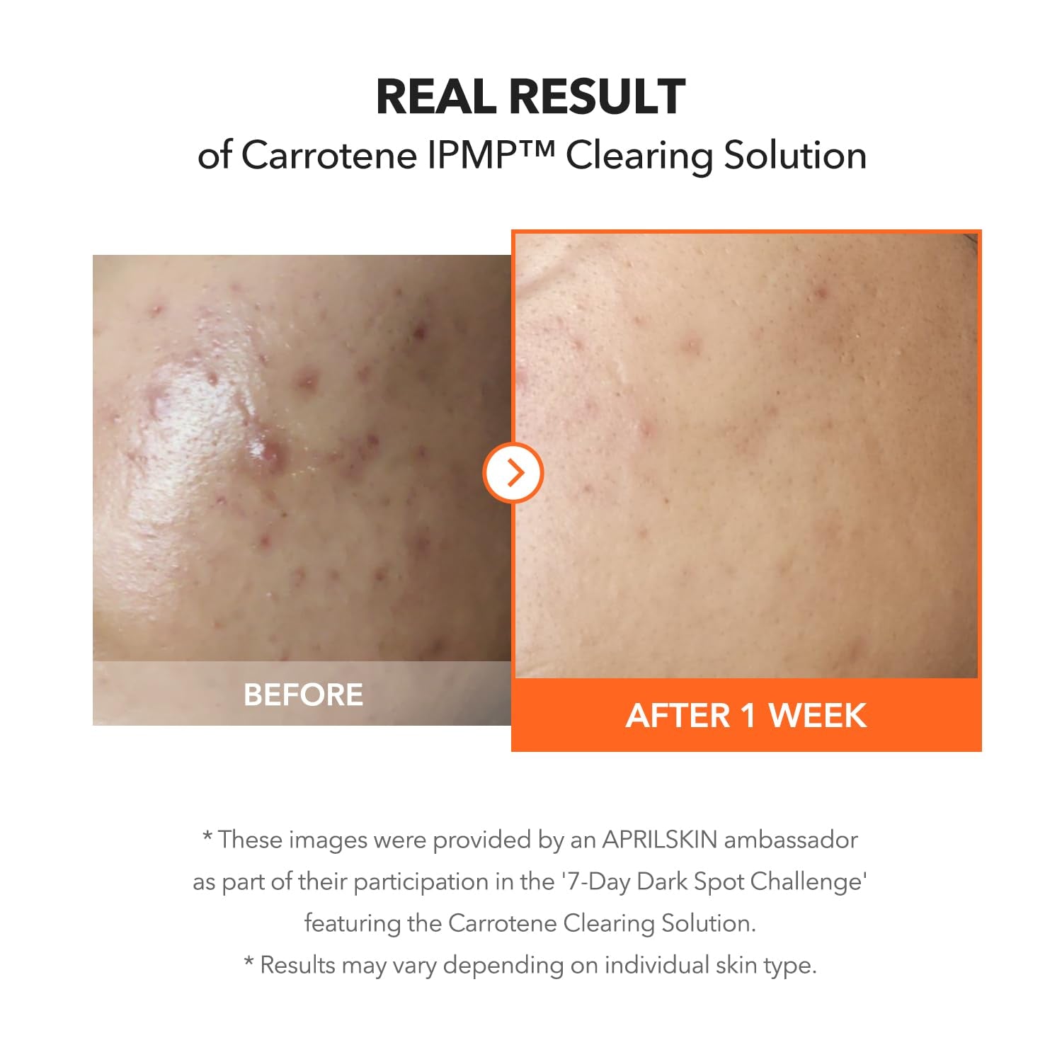Carrotene IPMP™ Clearing Solution || Quickly Soothes Troubled Areas and Helps Clear Blemishes | Formulated with BHA, AHA, Niacinamide & Zinc Oxide | Vegan, Cruelty-Free (0.67Fl.Oz.)